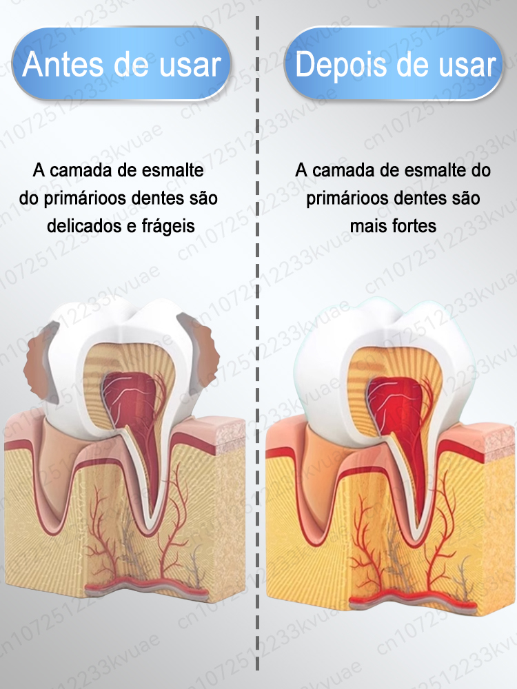 Creme dental anticárie remineralização recuperação esmalte reparação fortalecimento restauração cárie proteção dental dentes