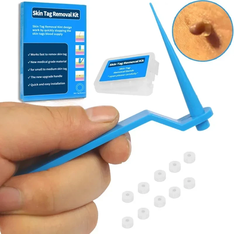 1 Set Skin Tag Removal Kit Skin Mole Wart Remover Micro Band Skin Tag Removal Kit Tag Treatment Tools Set with Cleansing Swabs