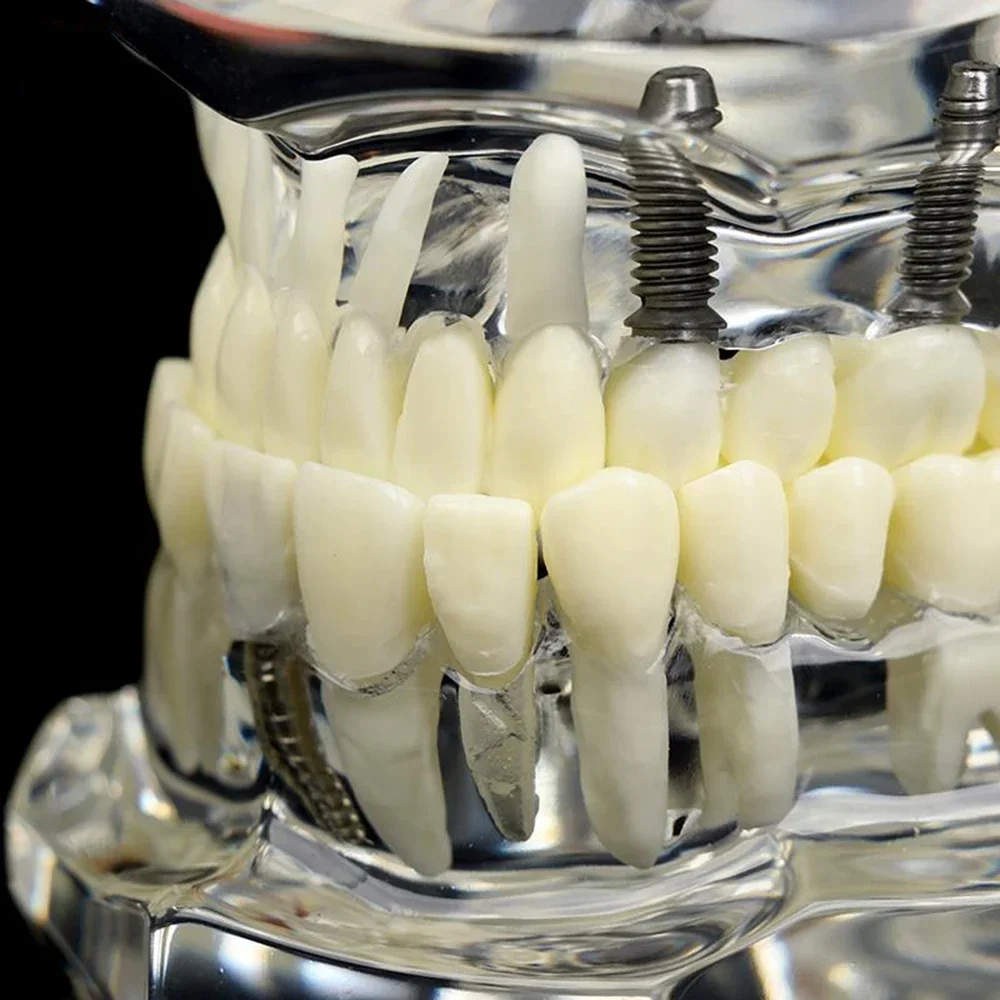 Modelos dentales Modelos de resina reparables de dientes enfermos para enseñar y investigaciones en medicina y enfermedades dentales