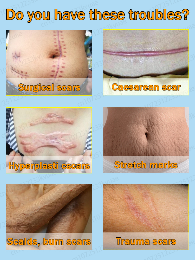 Crema para eliminar cicatrices. Elimina eficazmente las cicatrices de heridas y repara las cicatrices.