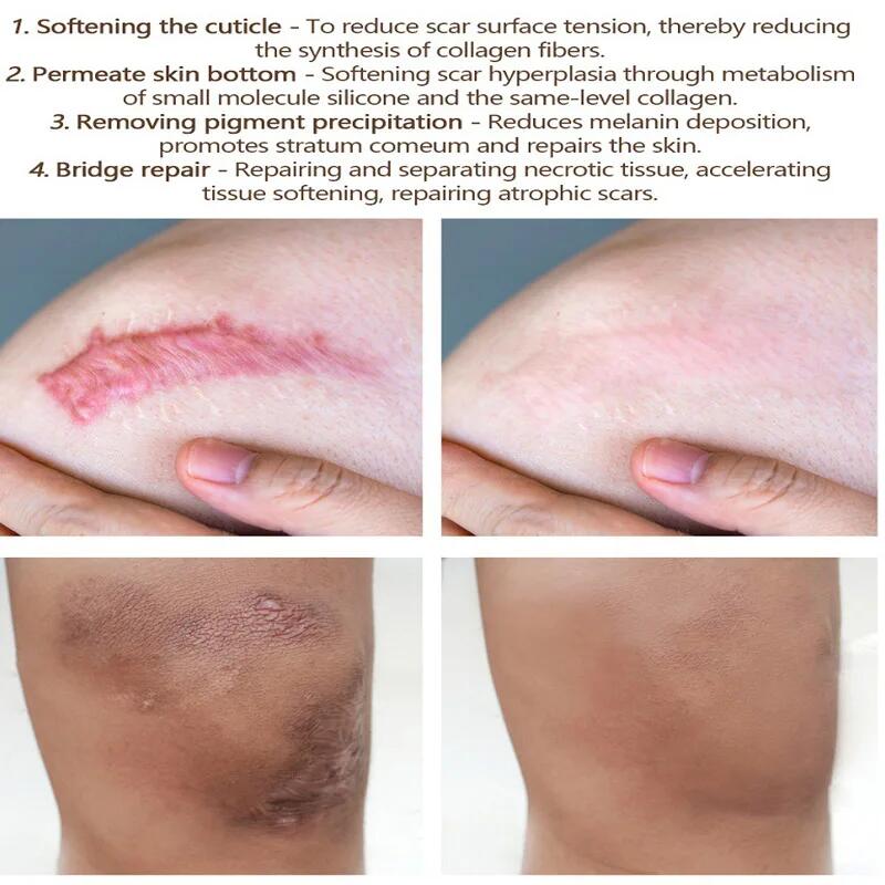 Crema de eliminación rápida de cicatrices, tratamiento efectivo, estrías, quemaduras, cicatrices quirúrgicas, reparación de manchas de acné, blanqueamiento, hidrata, cuidado de la piel a base de hierbas