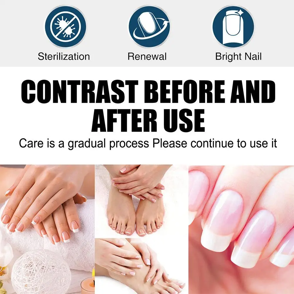 Pluma líquida para reparación de uñas, suero para tratamiento de hongos en las uñas, crema para los dedos de los pies, Gel antieliminación, reparación de hongos en los pies, infección líquida F4I6, 3 ML