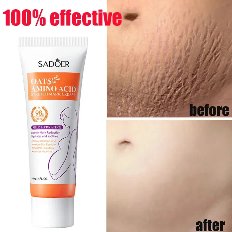 Continued use of Abdominal Scar Removal Cream eliminates signs of swelling, repairs cracks ，fades and improves fine stretch mark