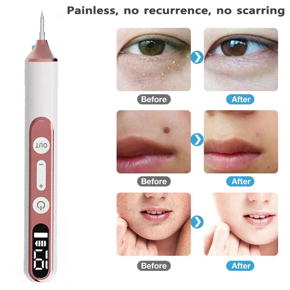 Haut Tag Remover Warze Eliminator Laser Plasma Stift Papillome Elektrische Sommersprossen Dark Spot Maulwurf Entfernung Haut Tag Remover Stift