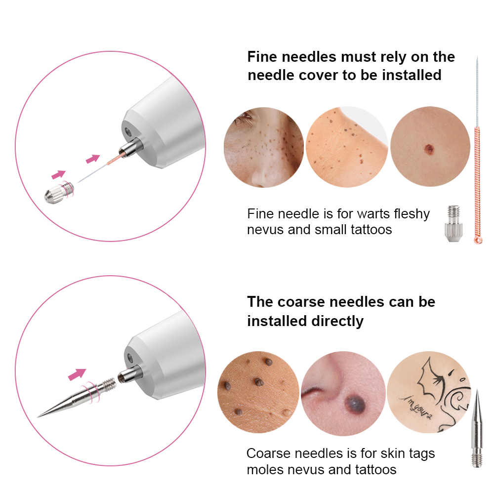 Plasma-Stift, Entfernung von Maulwurfswarzen, dunklen Flecken, schwarzer Punkt, Nevus, Sommersprossen, flacher Makel, Pickel-Entferner für Gesicht, Körper, Hautflecken-Entferner