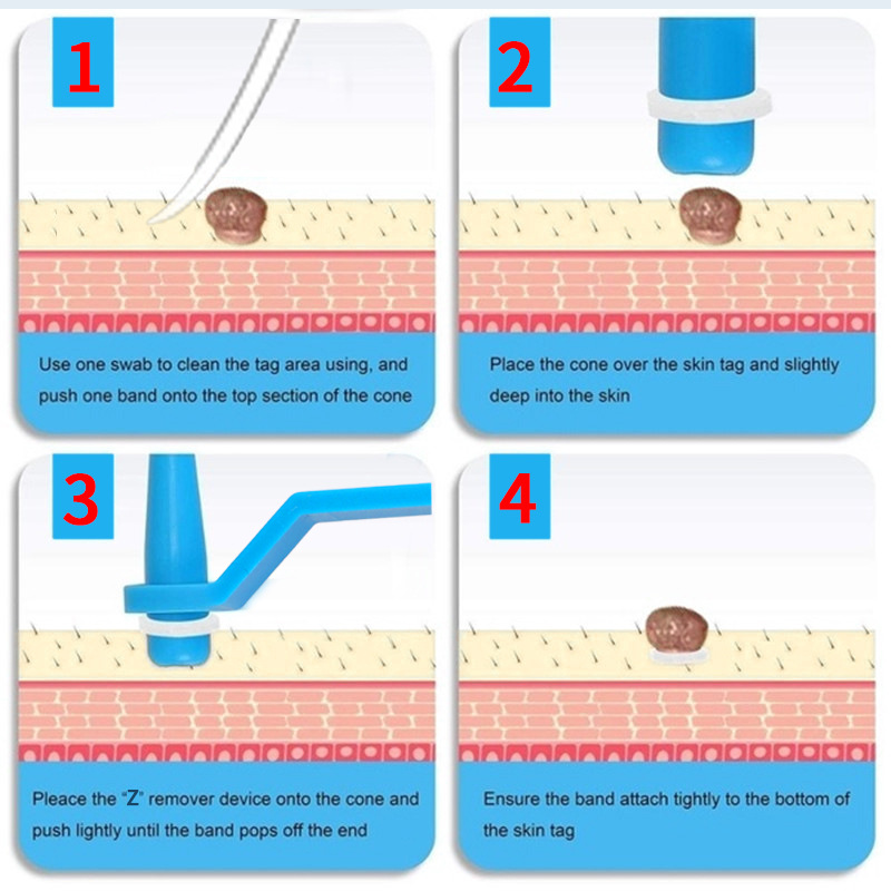 1 Set Skin Tag Removal Kit Skin Mole Wart Remover Micro Band Skin Tag Removal Kit Tag Treatment Tools Set Beauty Tools For 1-5mm