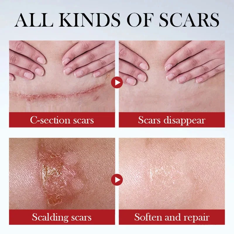 Crema para eliminar cicatrices, reparación de estrías, quemaduras de acné, ungüento quirúrgico para cicatrices de acné, tratamiento a base de hierbas, Gel blanqueador, belleza, cuidado de la salud