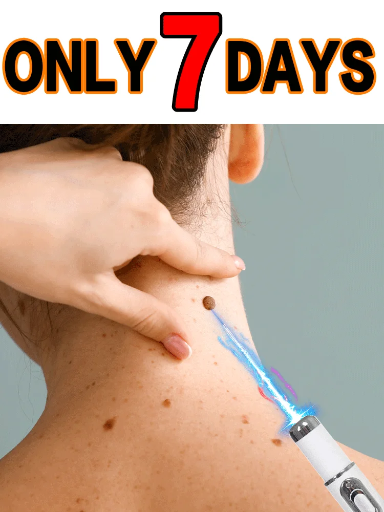 Hot selling blue light pen to solve body warts, wart care tools