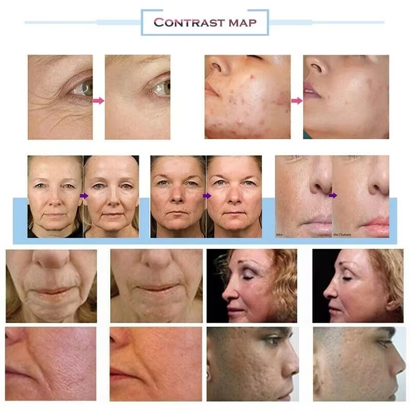 Professionelle Morpheus 8 RF Microneedling Maschine Gesichtspflege Schönheit mit 12 24 40 Nano Pin Patrone