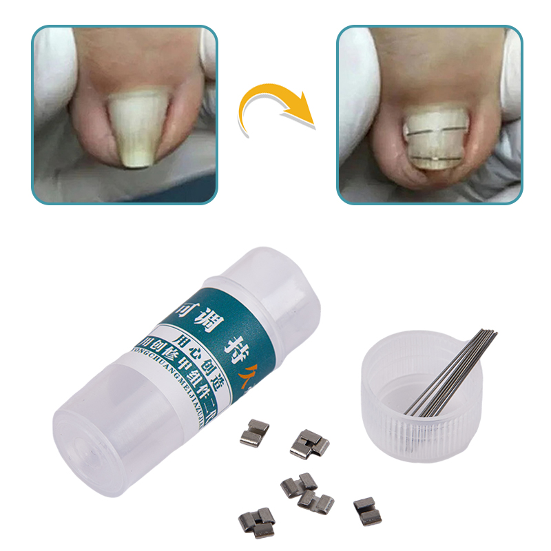 Corrector de uñas encarnadas, herramientas para pedicura, recuperación integrada, tratamiento de uñas de los pies, soporte profesional para alisar uñas encarnadas