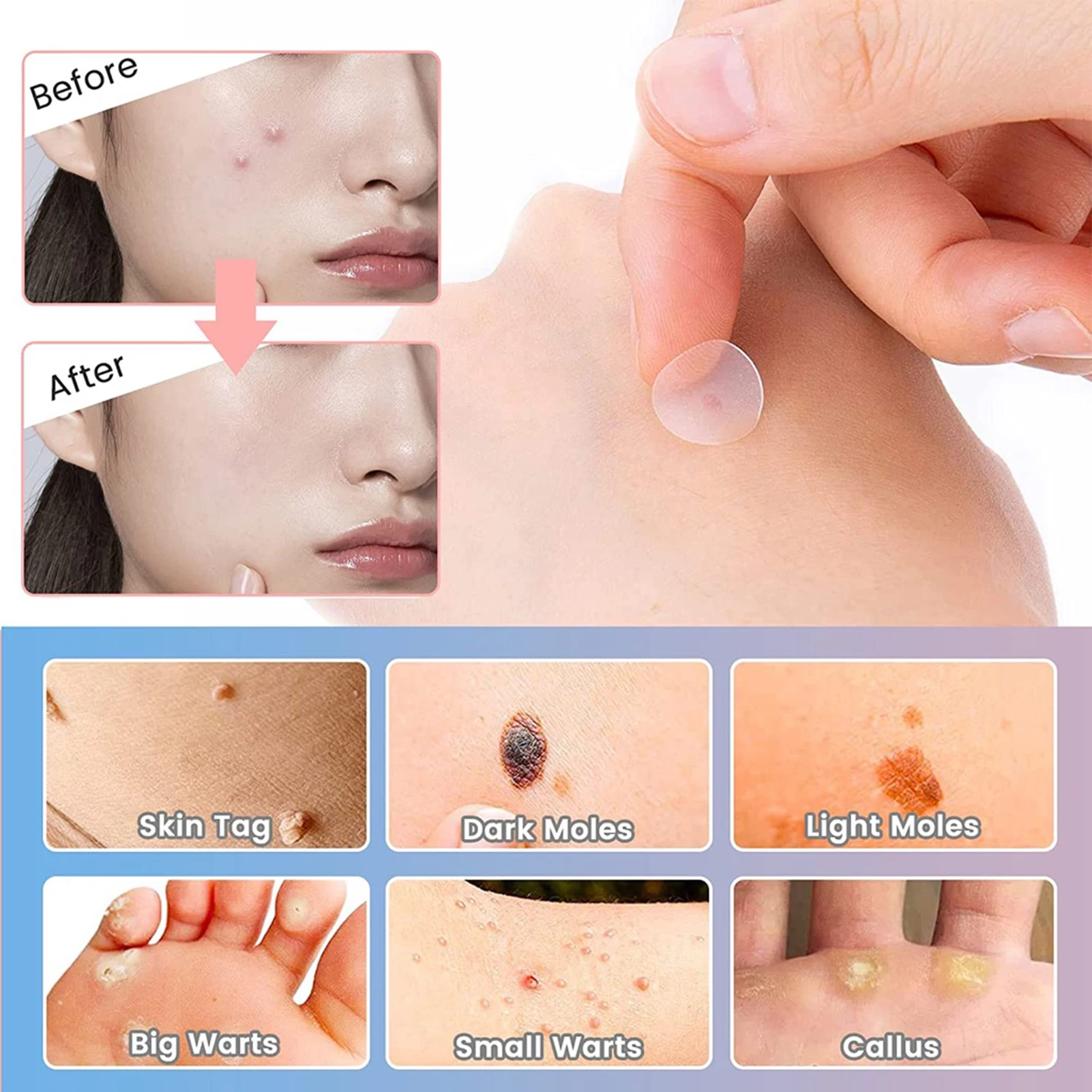 【ขายร้อน】 72 ชิ้นที่มองไม่เห็นกําจัดสิวป้องกันสิวไฮโดรคอลลอยด์แพทช์จุดเครื่องหมายคอนซีลเลอร์กันน้ําซ่อมสติ๊กเกอร์