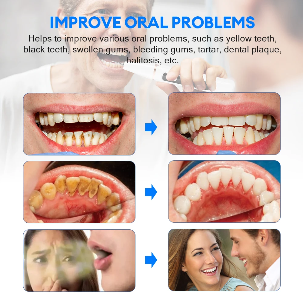 อัลตราโซนิกทันตกรรม Scaler การดูแลช่องปากกําจัดคราบหินปูนแคลคูลัส Remover ฟันคราบทําความสะอาดไฟ LED ฟันไวท์เทนนิ่งเครื่องมือในครัวเรือน