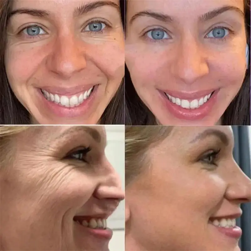 Removedor instantâneo de rugas, proteína de colágeno, conjunto de soro, levantamento, endurecimento, solúvel, absorvente, enchimento facial, anti-envelhecimento, cuidados com a pele