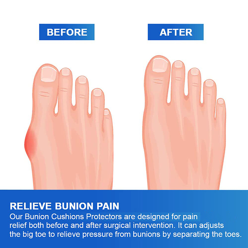 Pexmen 2/4Pcs Gel Bunion Cushions Protectors Sport Bunion Pad Toe Spacer set Bunion Corrector with Separator for Big Toe