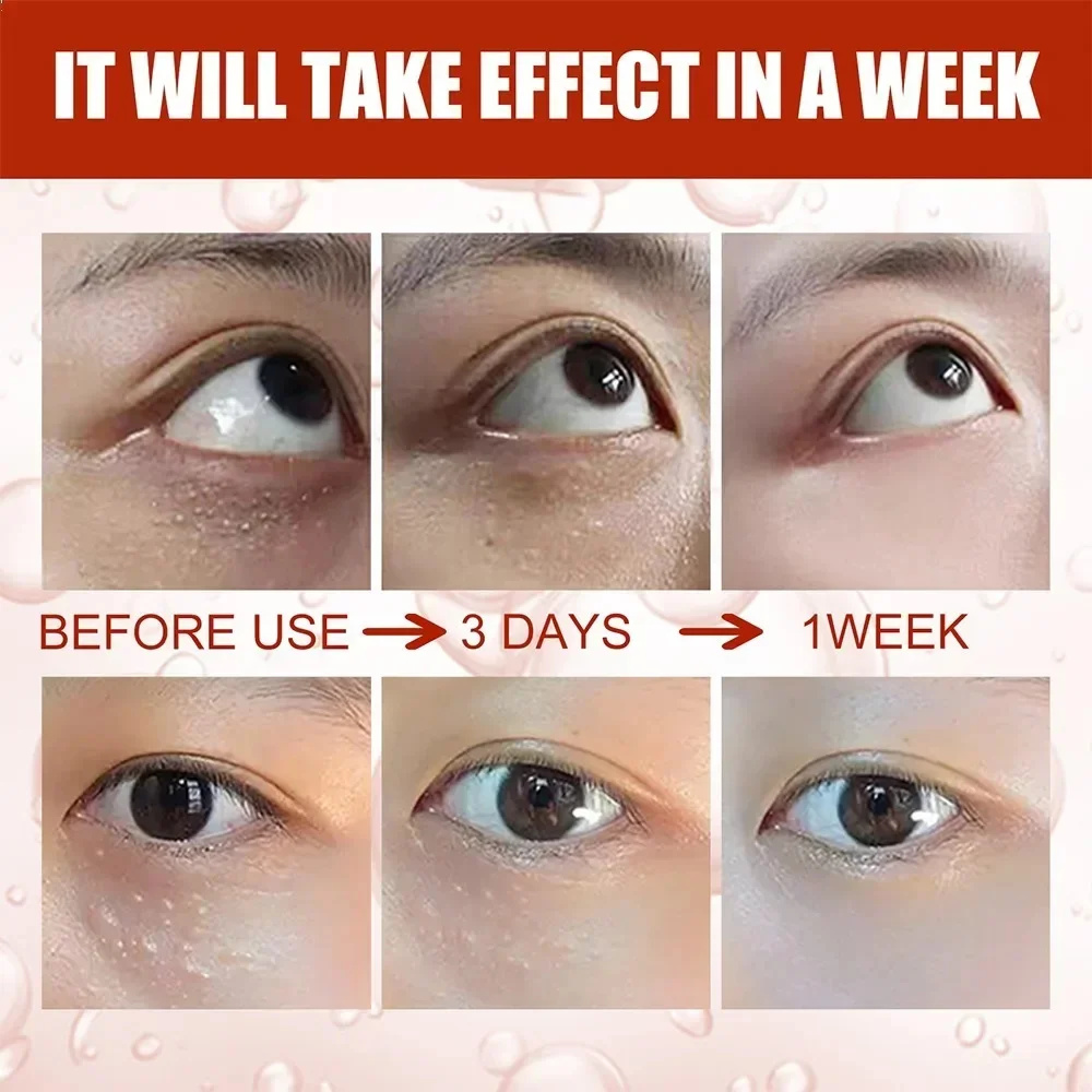 Crema para ojos eliminador de gránulos de grasa, crema firme antihinchazón, antiinflamatorio, Reduce las ojeras, desvanece las líneas finas, barrera reparadora Sk