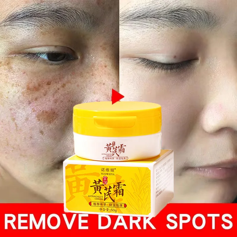 Efficace Sbiancamento Lentiggine Crema Per Il Viso Rimuovere Il Melasma Macchie Scure Dissolvenza Pigmentazione Cicatrici da Acne Idratante Illuminare La Cura di Bellezza