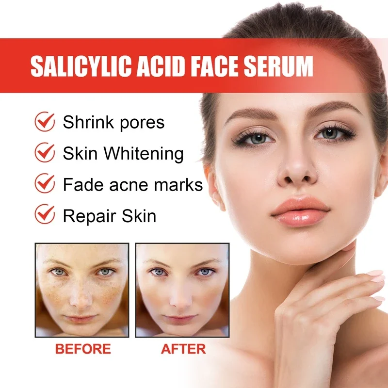 Nicotinamida que atenúa las manchas, esencia Facial, ácido salicílico, reduce los poros, eliminación de pecas, hidrata, productos para el cuidado de la piel 2024