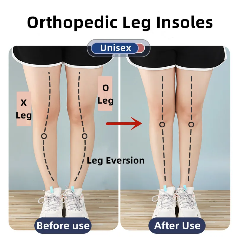 Solette ortopediche in silicone per piedi O/X Tipo gamba Valgo Varus Gel di correzione Scarpe Sottopiede Magnete Massaggio Cuscinetti per la cura del piede