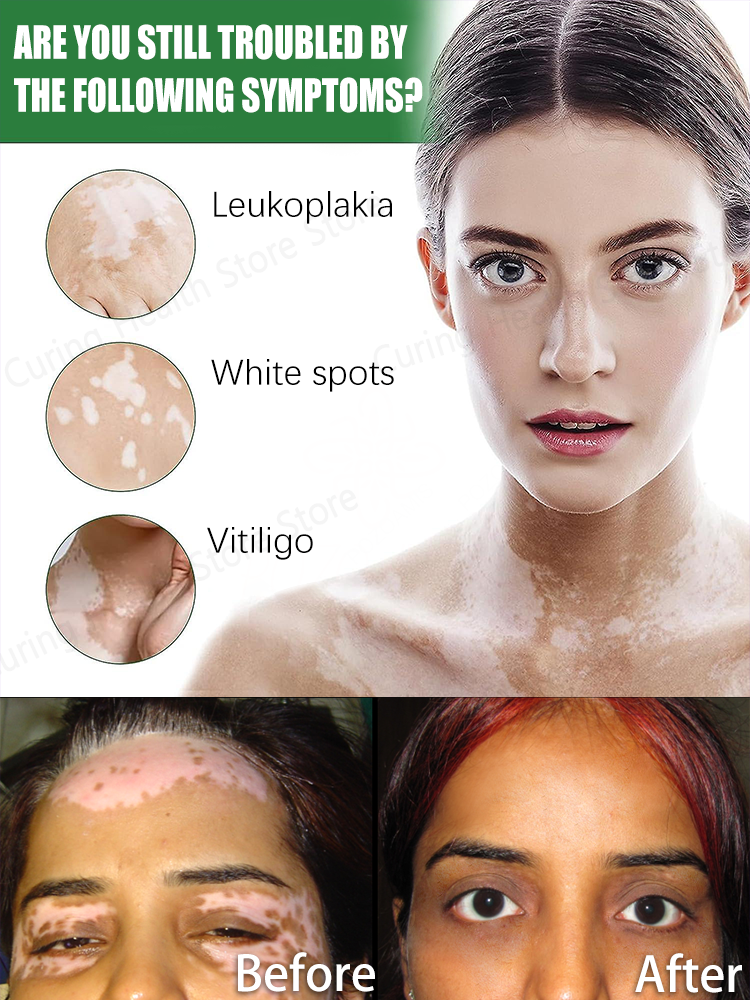 лазерный витилиго