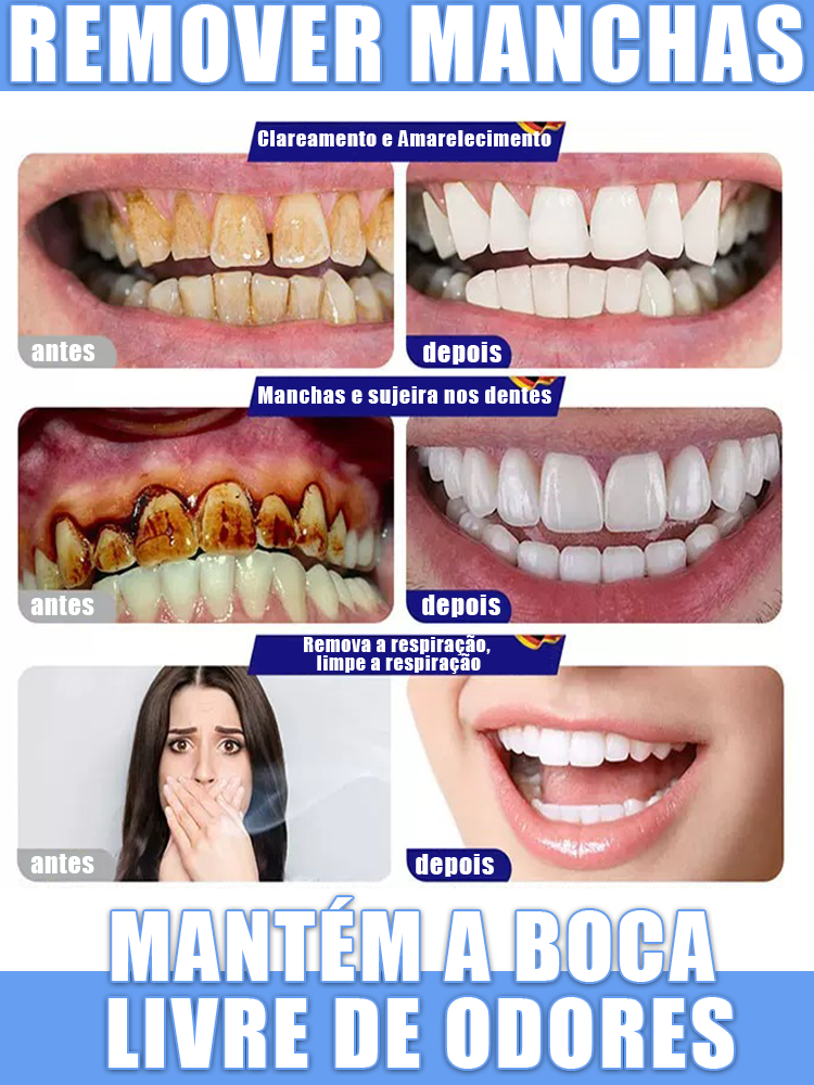 Clareamento dentário, restauração gengival rápida e natural, avaliações de usuários extremamente positivas