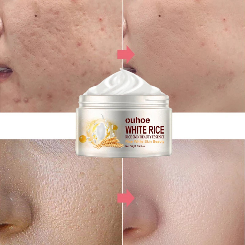 Crema Facial antiarrugas de arroz, tratamiento de melasma para acné, pigmentación, blanqueamiento, Estiramiento Facial, crema hidratante de belleza, Cosméticos Coreanos 30g