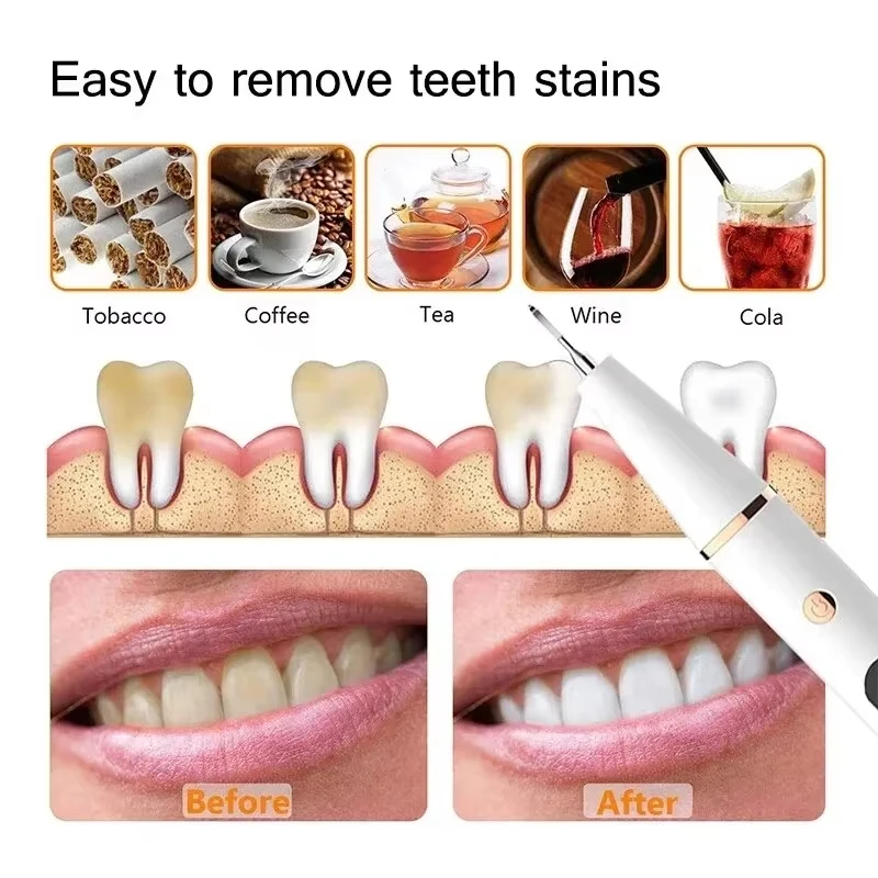 ไฟฟ้าโซนิคทันตกรรมแคลคูลัส Scaler ช่องปากฟัน Tartar Remover แผ่นคราบทําความสะอาดกําจัดฟันไวท์เทนนิ่งแบบพกพา