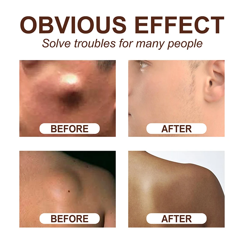 Skin Care Soothing Knot Care ครีมใต้ผิวหนังก้อน Remover บรรเทา Body Agglomeration Hard Blocks Body Skin Care ครีม