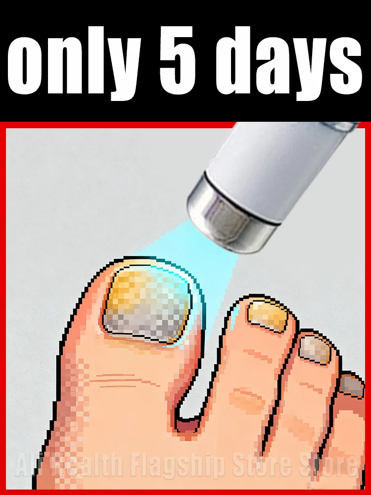 The fifth generation of champagne-colored nail laser penʜᴇʟᴘs ʏᴏᴜ sᴀʏ ɢᴏᴏᴅʙʏᴇ ᴛᴏ ᴏɴʏᴄʜᴏᴍʏᴄᴏsɪs. Tᴇᴄʜɴᴏʟᴏɢʏ ᴄʜᴀɴɢᴇs ʏᴏᴜʀ ʟɪharᴇ。