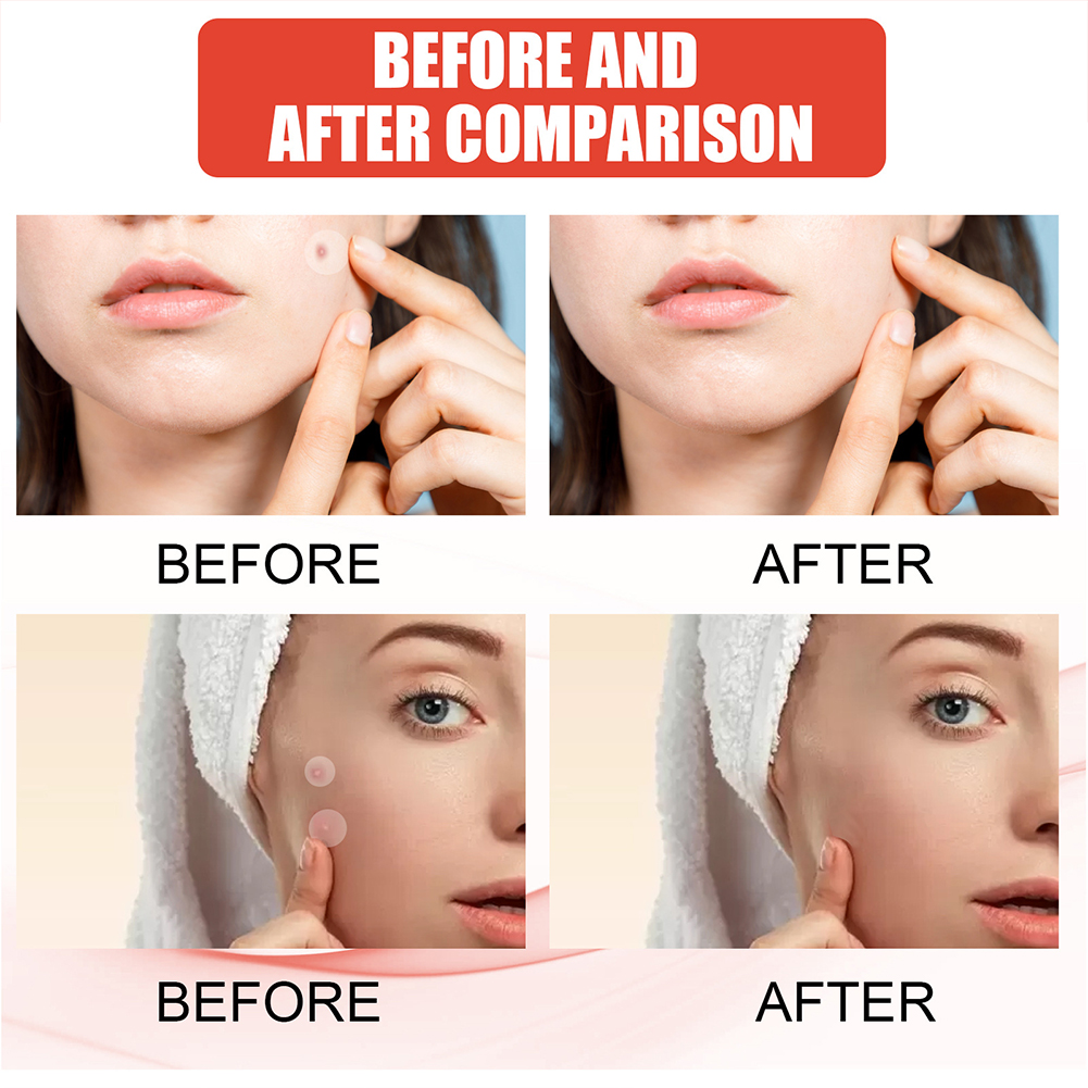144 pz/set Viso Cura Della Pelle Acne Brufolo Patch 2 Formati Invisibile Guarigione Professionale Assorbente Spot Adesivo di Copertura per Le Donne Degli Uomini