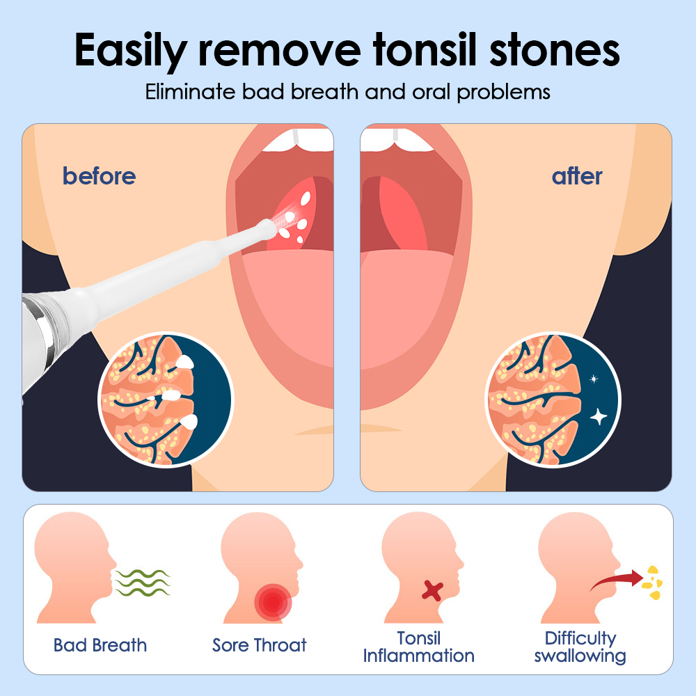 Electric Tonsil Stone Remover Vacuum Tonsil Stone Removal Kit With Oral Irrigation Syringe Tonsil Stone Removal 3 Suction Modes