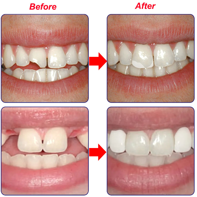 ชั่วคราวเรซิ่นฟันซ่อมกาว Shapeable ฟันช่องว่างฟันปลอมกาวแข็งบรรจุกาวฟันปลอมอุปกรณ์ทันตกรรมเครื่องมือ