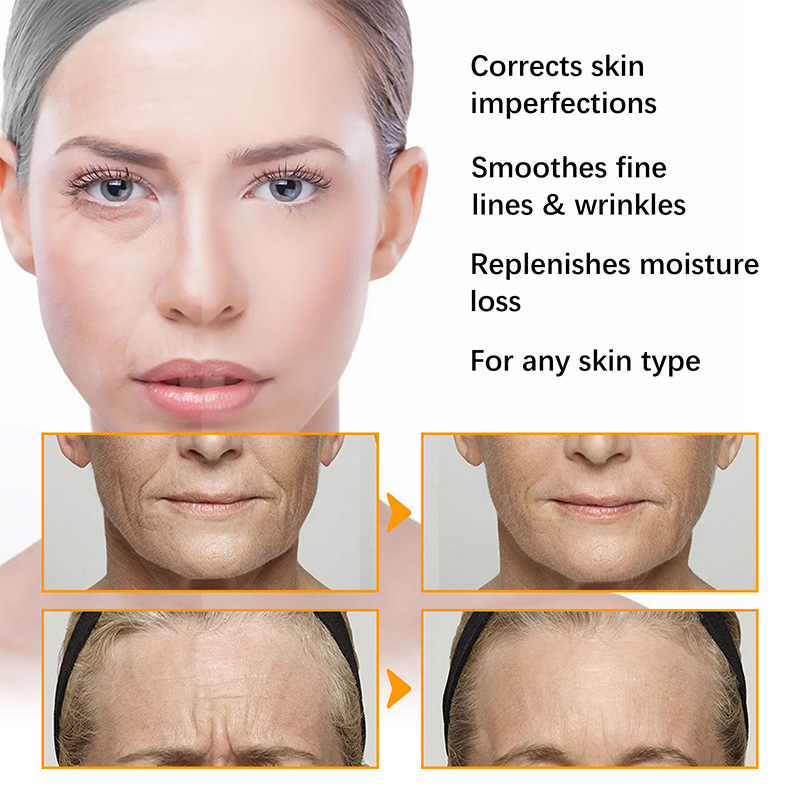 Anti Acne Turmeric Cream, Fades Scars & Dark Spots, for Oily and Dull Skin, Brightening Turmeric Face Care Treatment, 50ml