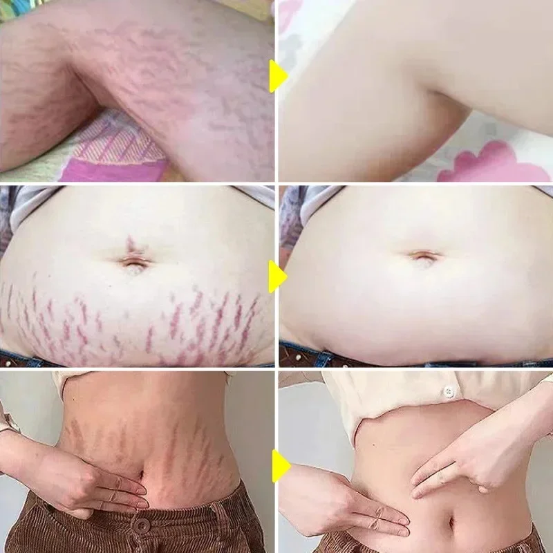 Continued use of Abdominal Scar Removal Cream eliminates signs of swelling, repairs cracks ，fades and improves fine stretch mark