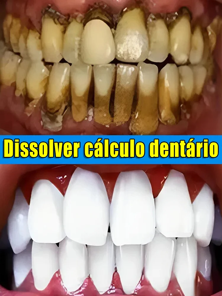 Os removedores de tártaro dissolvem tártaro e removem manchas