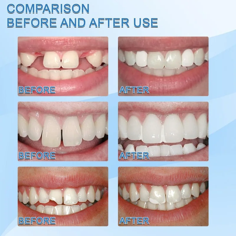 Kit de reparación de dientes moldeables, Kit de reemplazo Dental temporal, cuentas térmicas moldeables para rellenar los dientes faltantes y rotos falsos