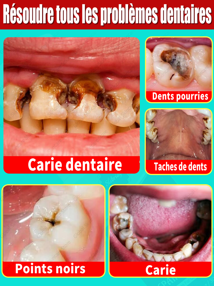 ToChaînes Réparation de la carie