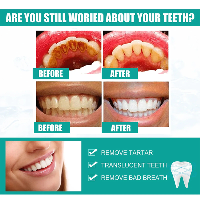 Removedor de cálculo Dental, Spray blanqueador de dientes, cuidado del aliento fresco, pasta de dientes, limpieza, higiene bucal, eliminación de halitosis, manchas de placa