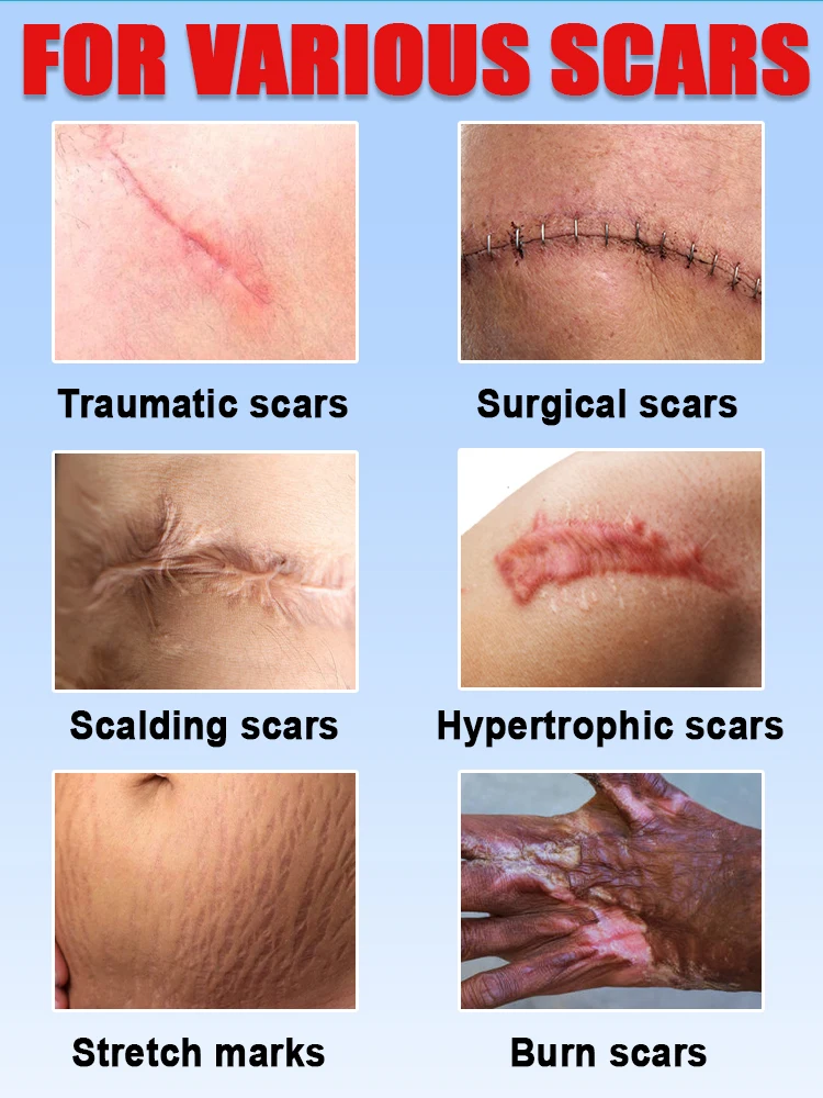 Watching the scars disappear