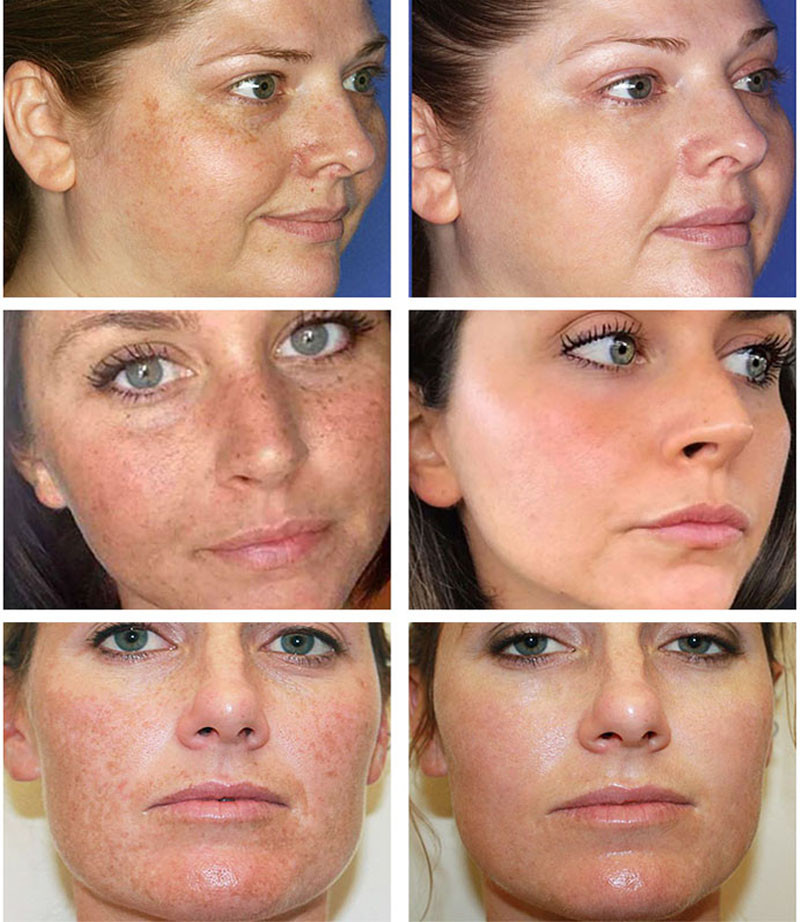 Whitening Freckle Cream Melasma Pigmentation Remove Nicotinamide Serum Cream Pores Refining Black Spot Acne Marks Removal Cream