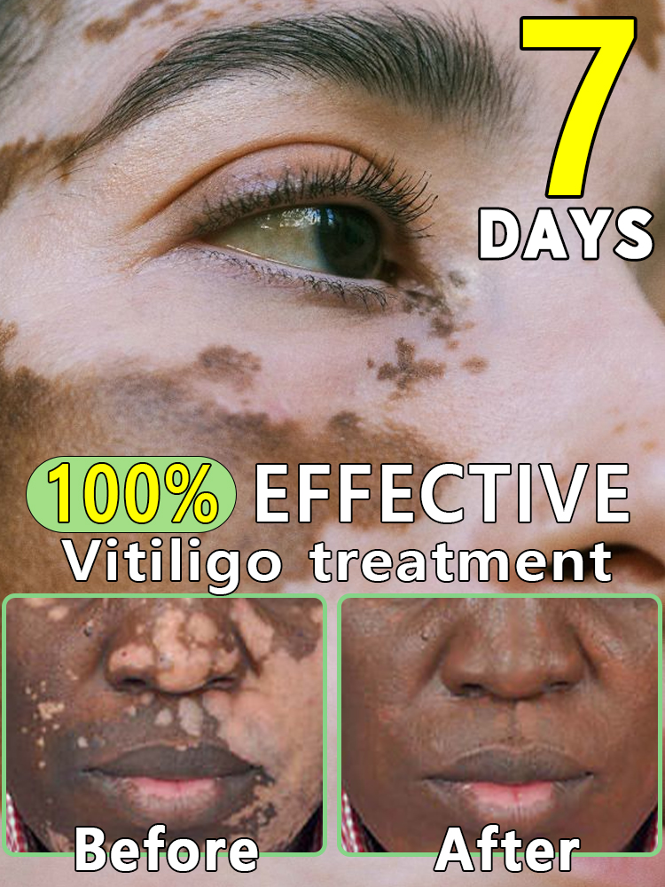 Migliora la pigmentazione della pelle e riduce le macchie bianche Crema per il trattamento della vitiligine Non c'è più traccia di vitiligine. L'essenza di estratto vegetale ha salvato la mia pelle dal pericolo