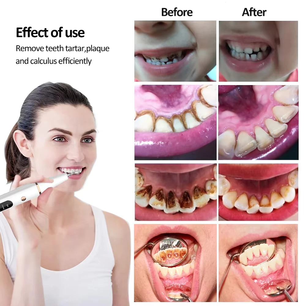 อัลตราโซนิกทันตกรรมแคลคูลัสRemoverฟันแผ่นScaler Tartar Eliminatorคราบทําความสะอาดไฟฟ้าทันตกรรมฟันหินRemover