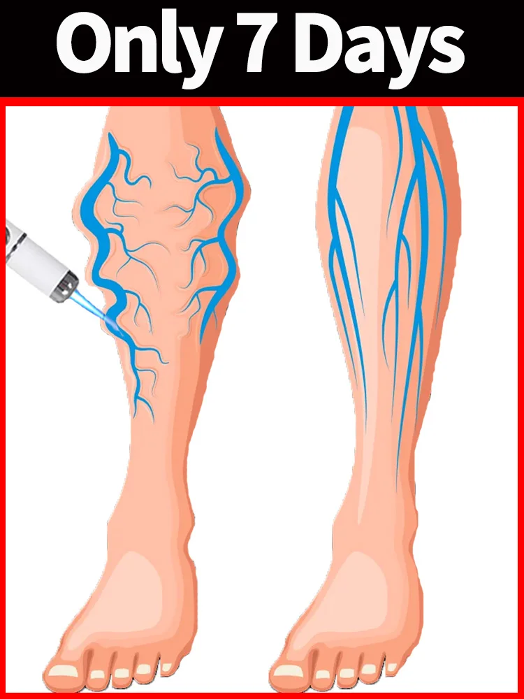 blue light pen solve varicose veins, hot sale leg care tools