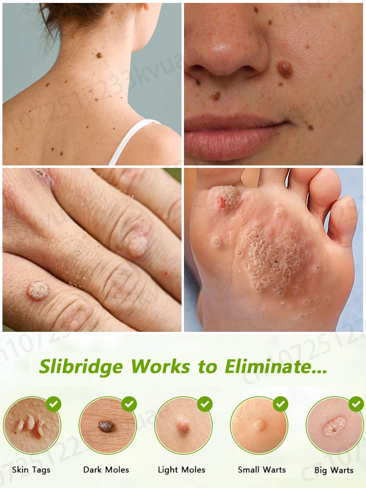 ᴸᵃˢᵉʳ ᵖᵉⁿ ᵃᶜᶜᵘʳᵃᵗᵉˡʸ ʳᵉᵐᵒᵛᵉˢ warts without scarring or recurrence
