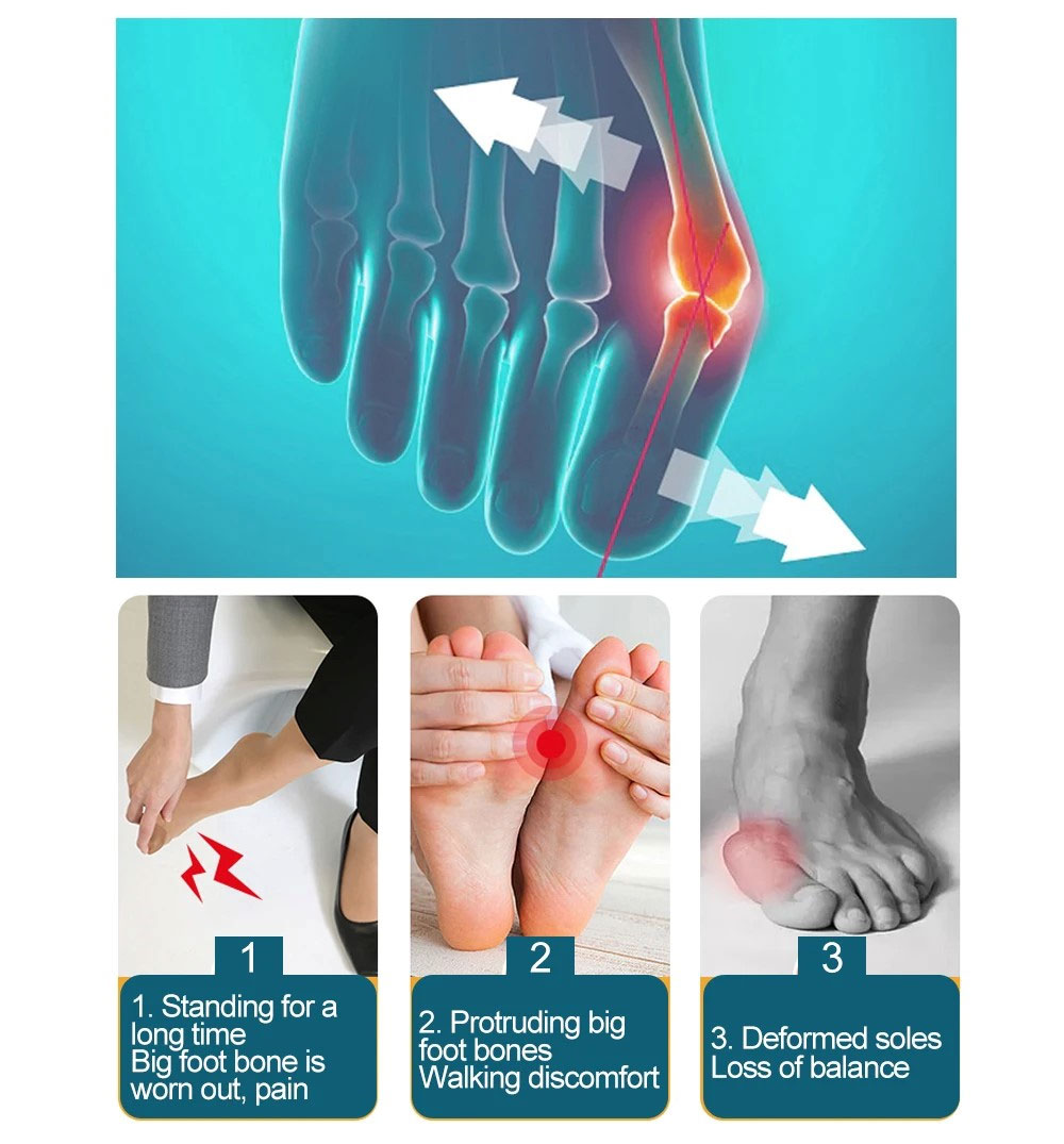 Separador de dedos de los pies, Corrector ortopédico de juanete Hallux Valgus, ajustador de hueso de los pies, Corrector de pulgar, alisador de calcetines de pedicura, 1 par