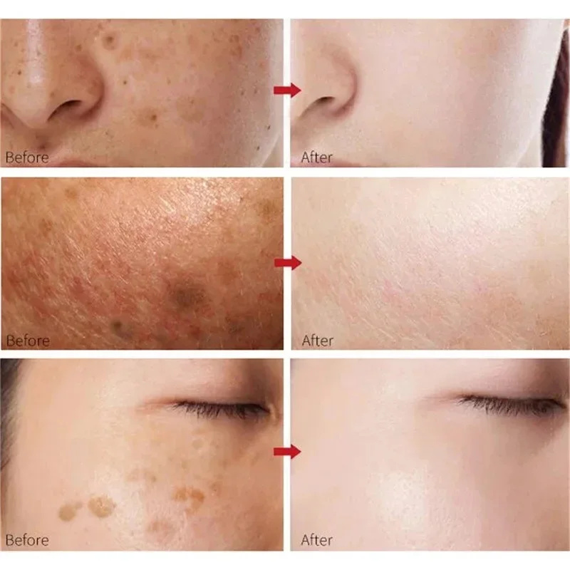Suero de niacinamida, corrector de manchas oscuras, hidratante, brillo, decoloración de líneas finas, limpieza profunda, removedor de maquillaje, cuidado de la piel coreano