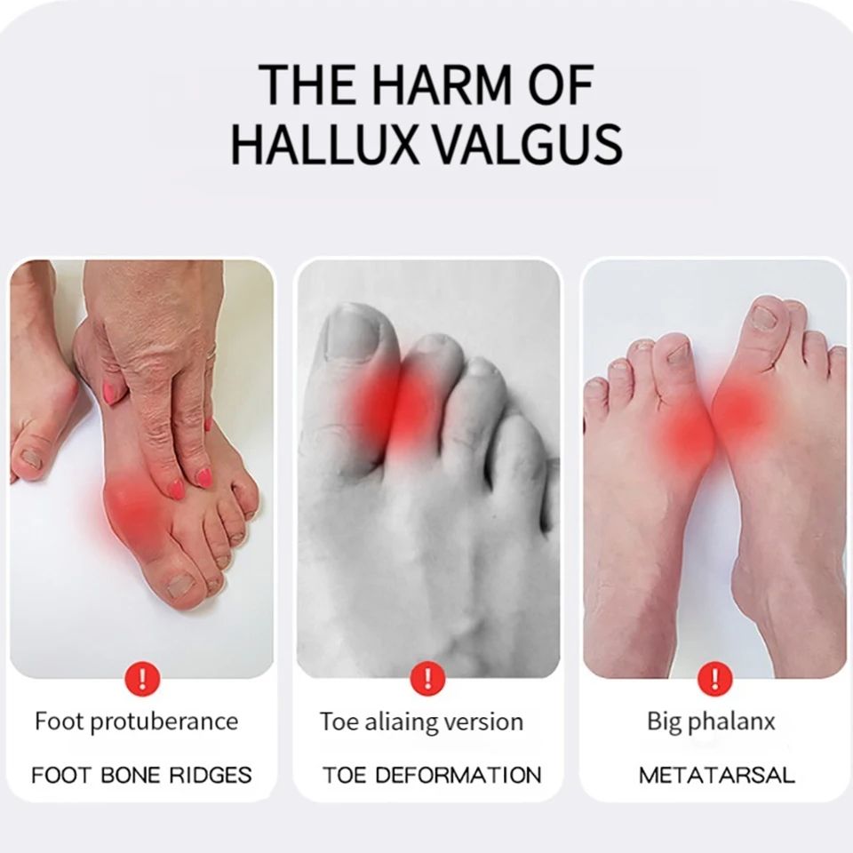 Corrector de juanete para aliviar el Hallux Valgus, separador del dedo gordo del pie, alisador del dedo gordo del pie fijo, alivio del dolor en las articulaciones, 1 Uds.