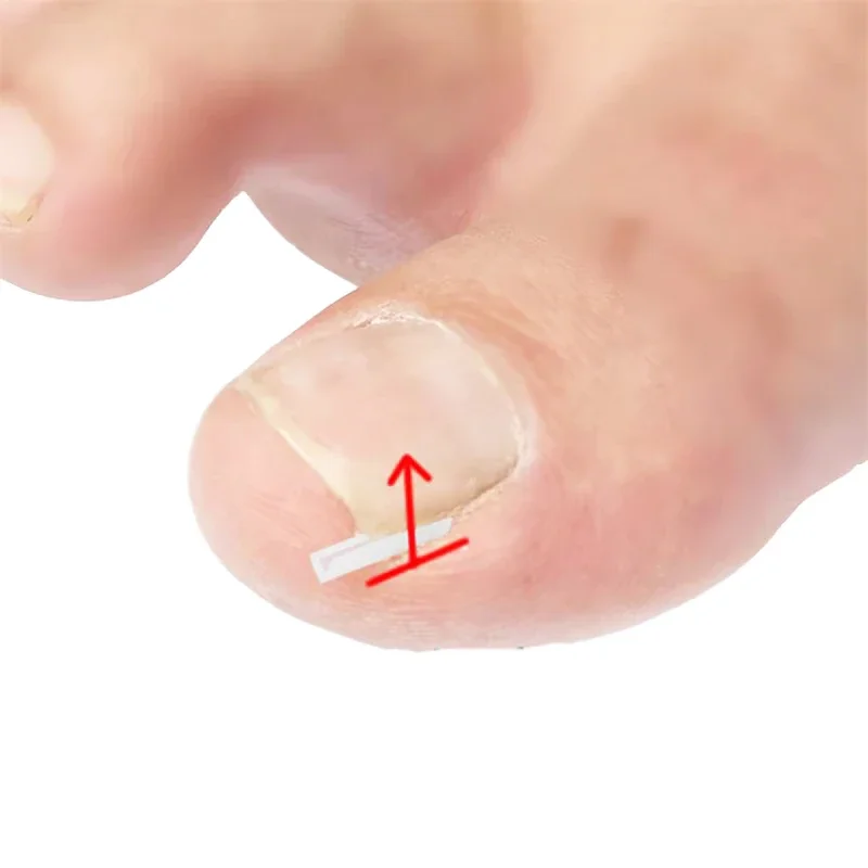 50 pezzi adesivo patch elastico strumento per pedicure strumento per la correzione dell'unghia del piede incarnita trattamento delle unghie incarnite raddrizzamento clip tutore