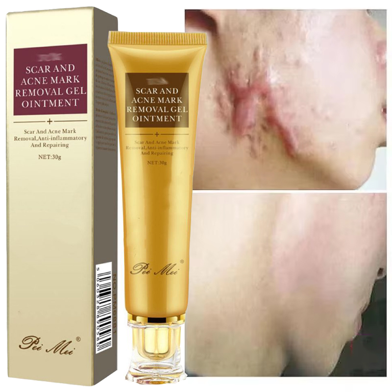 Crema de eliminación rápida de cicatrices, tratamiento efectivo, estrías, quemaduras, cicatrices quirúrgicas, reparación de manchas de acné, blanqueamiento, hidrata, cuidado de la piel a base de hierbas