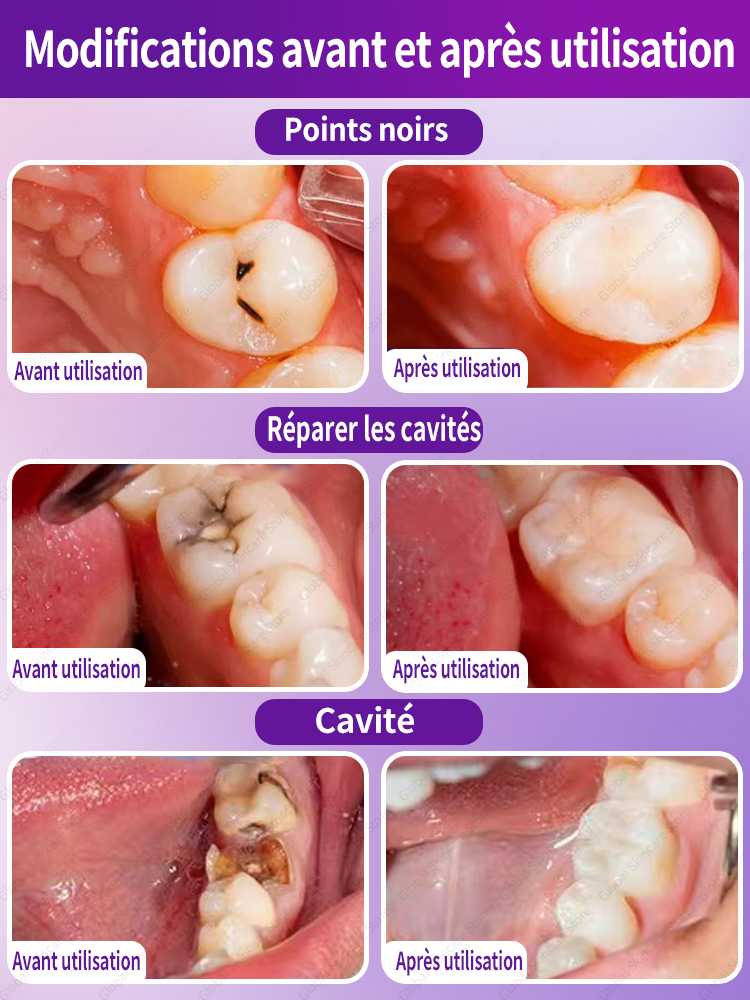 ToChaînes Réparation de la carie