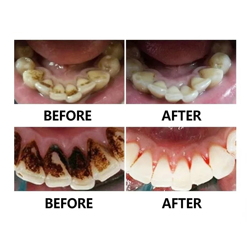 Stainless Steel New Dental Basic Teeth Whitening Mirror Scaler Tweezers Dentist Examination Set Prepared Tool Set Tweezer